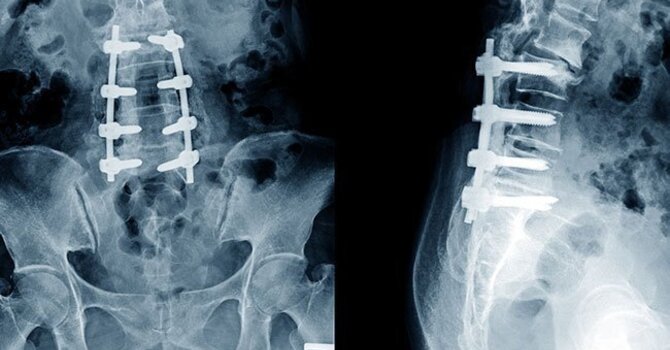 Avoid serious surgery from disc herniation and disc bulges image