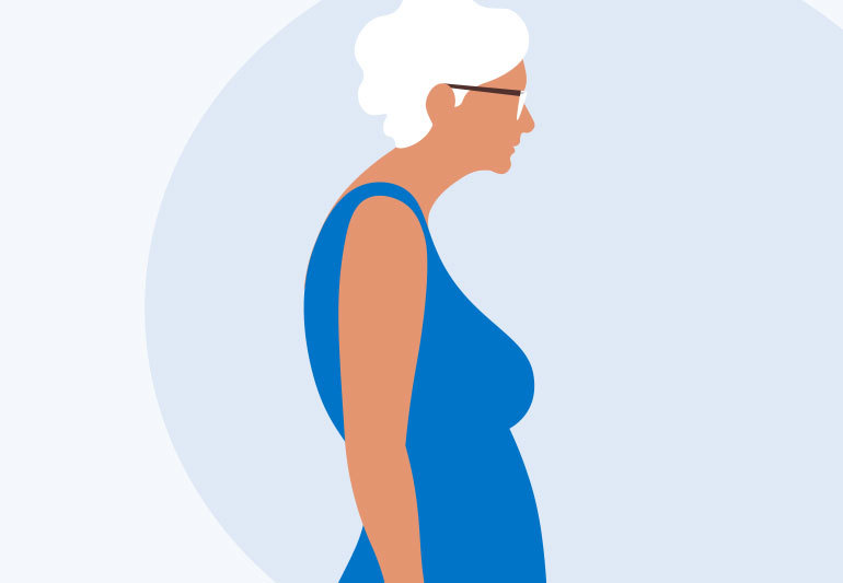 Dowager's Hump Benton Chiropractic Clinic