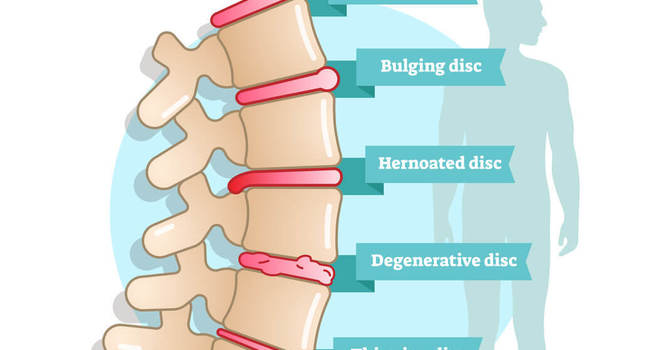 Disc Bulge vs Disc Herniation image